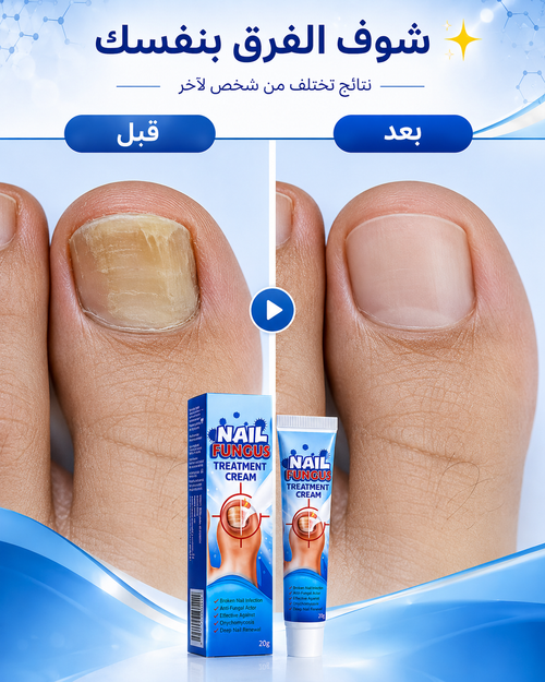 علاج فطريات الأظافر | Nail Fungus Treatment